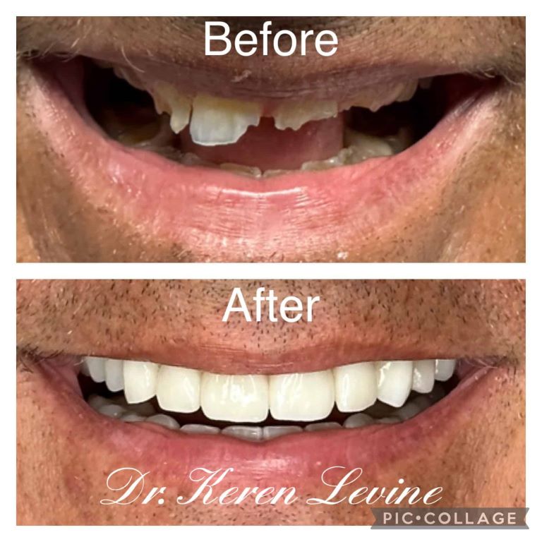 before and after full mouth restorations
