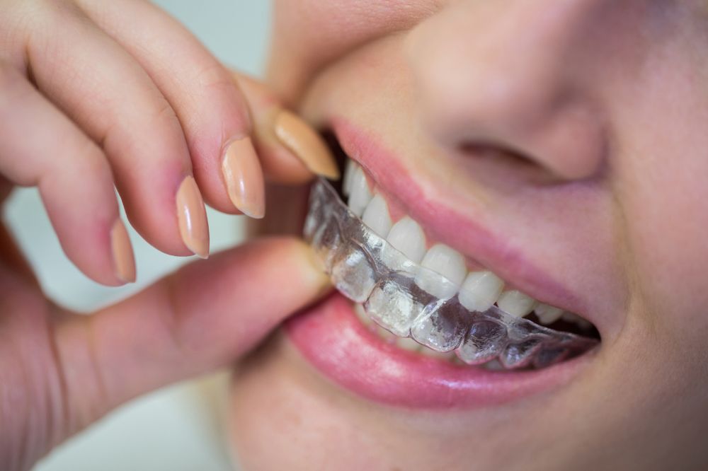a lady is putting invisalign on her teeth