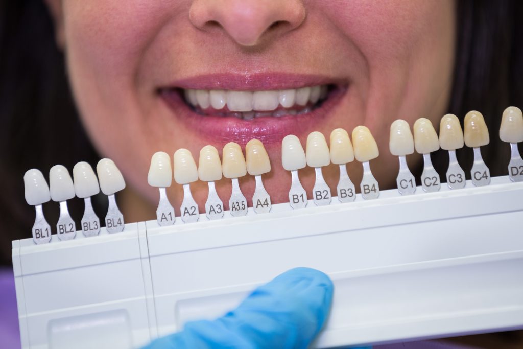 What Are Composite Veneers? Benefits, Procedure, And Results