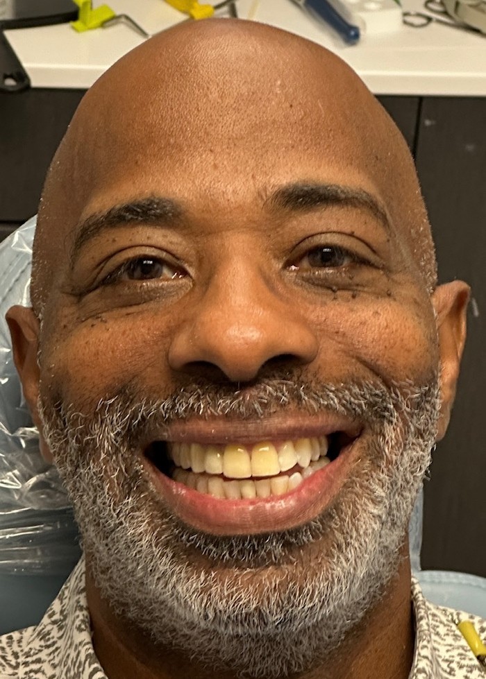 After — Invisalign