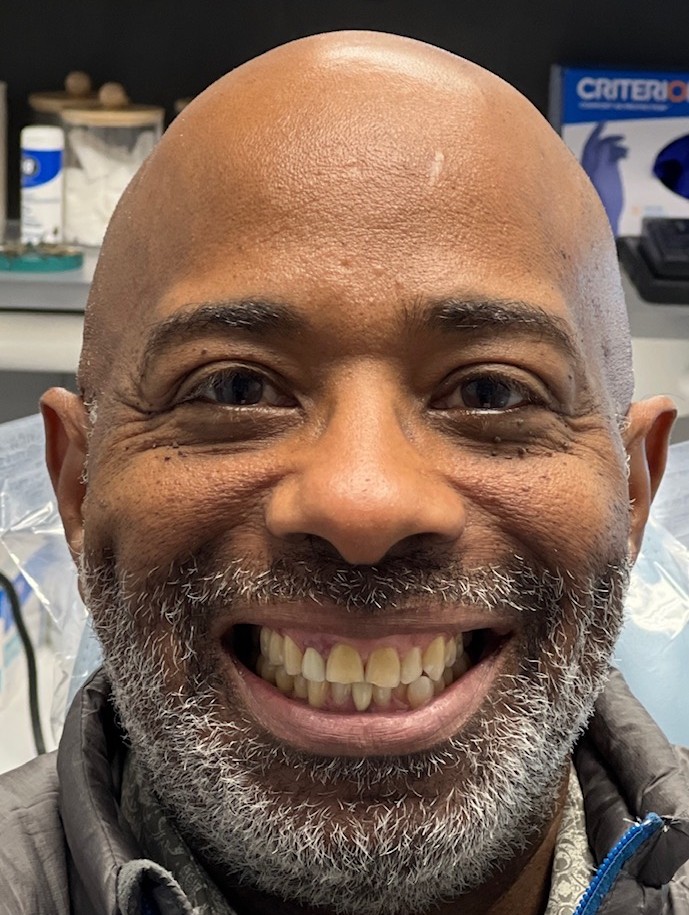 Before — Invisalign
